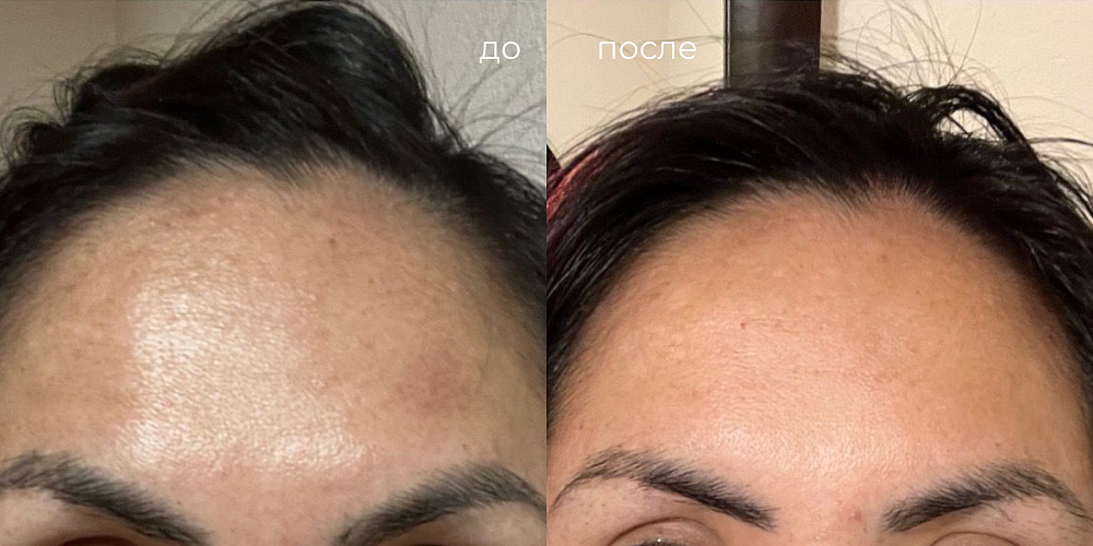 Результат до и после применения препарата