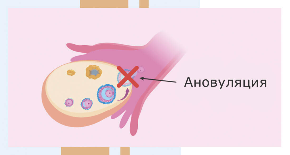 Ановуляция что это. Ановуляция. Отсутствие овуляции. Признаки ановуляции. Ановуляция симптомы.