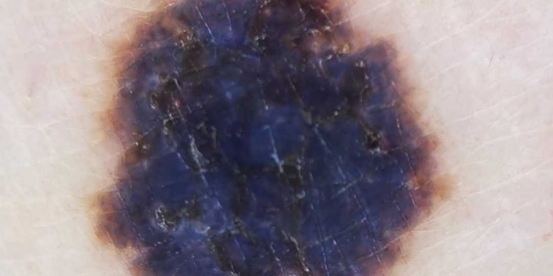 Меланома или диспластический невус?