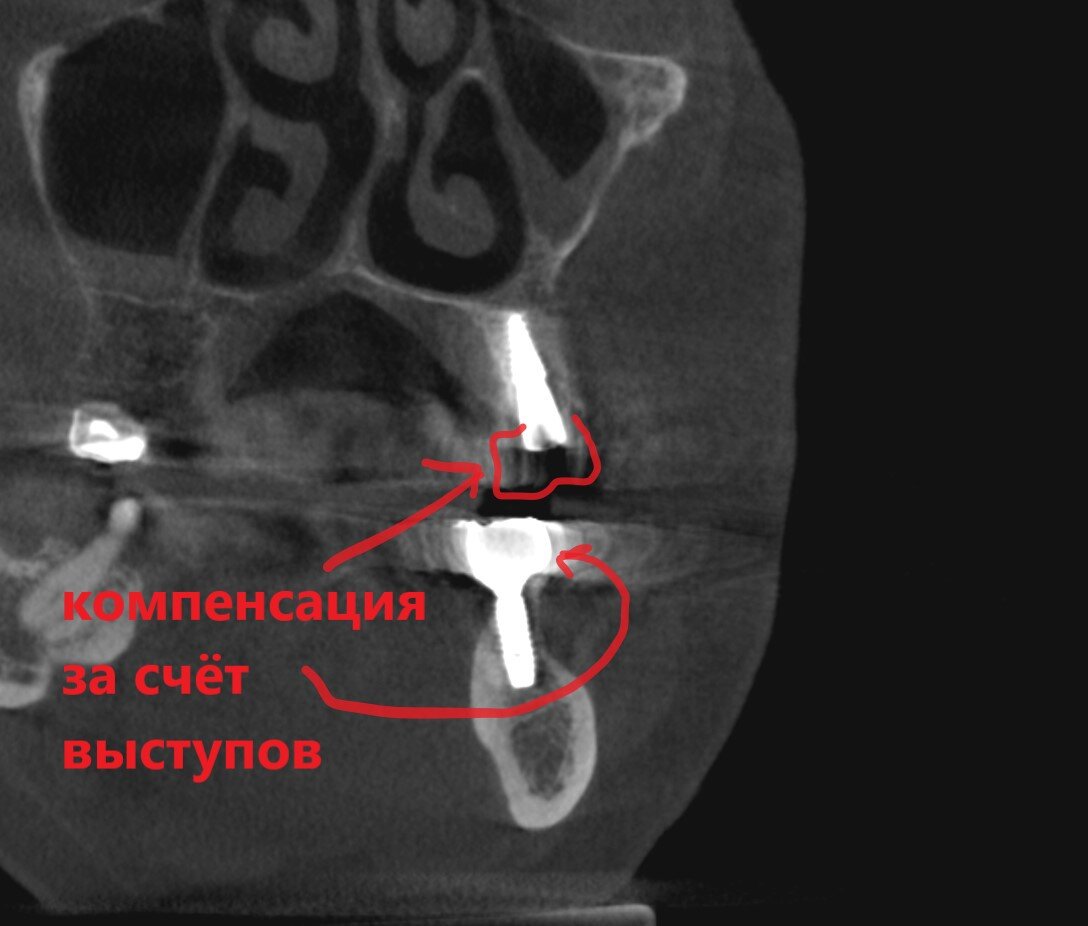 Разрыв шаблона - цифровая стоматологическая бутафория | Parodoctor | Дзен