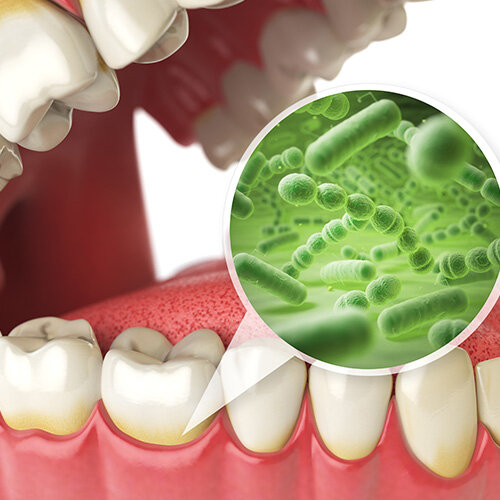 Причины галитоза (плохого запаха из-за рта)