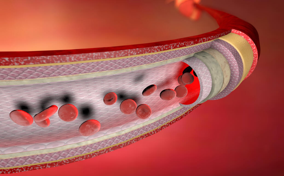 здоровые сосуды. деструкция кровеносных сосудов это. атеросклеротические поражения периферических сосудов. тромбофлебит глубоких вен нижних конечностей клиника. Xience alpine стент.
