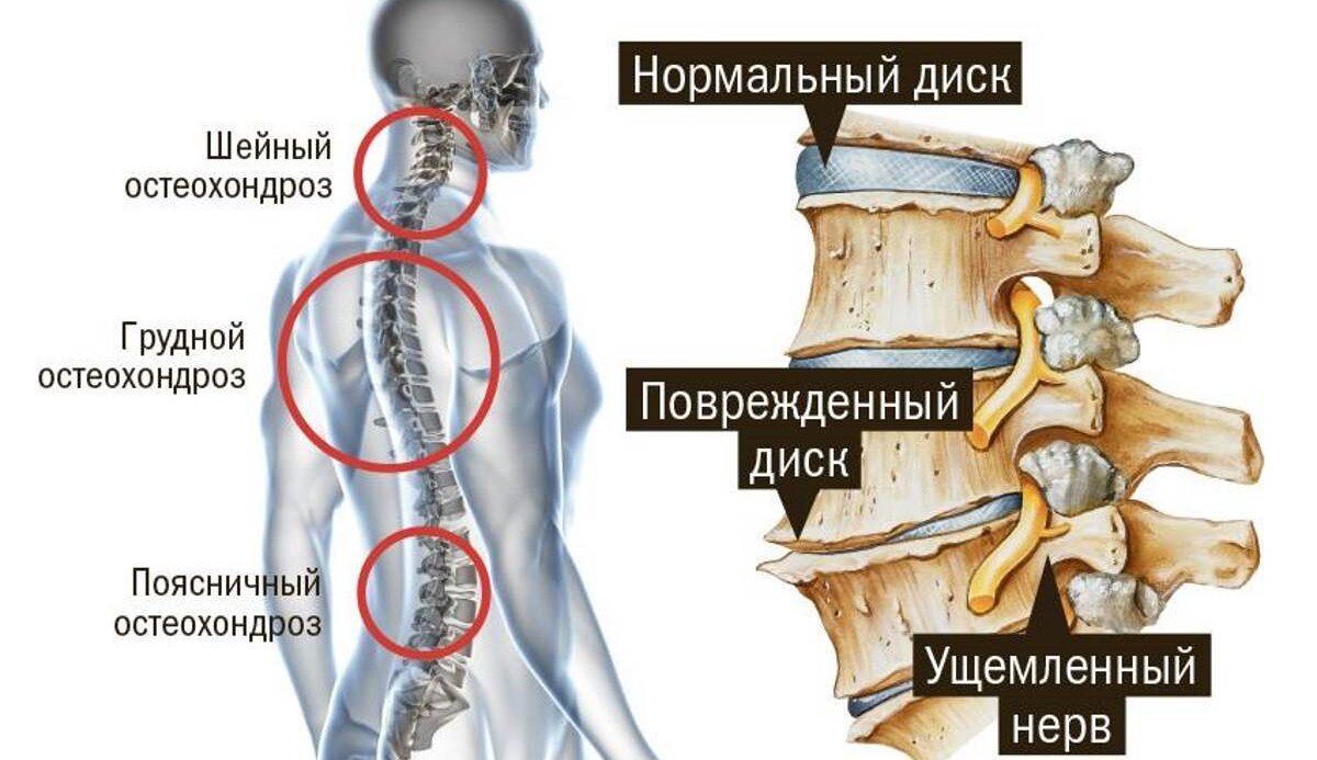 Остеохондроз с преимущественным поражением. Остеохондроз пояснично-крестцового отдела шейного и грудного отдела. Остеохондроз грудного поясничного отдела позвонка. Межпозвоночный остеохондроз грудного отдела симптомы. Шейный грудной поясничный остеохондроз