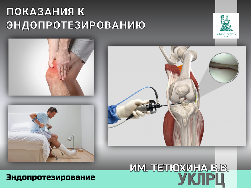 ПОКАЗАНИЯ К ЭНДОПРОТЕЗИРОВАНИЮ
