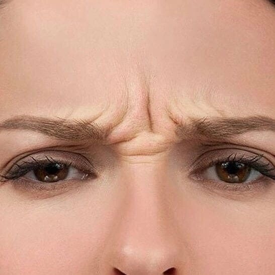 Межбровные морщины