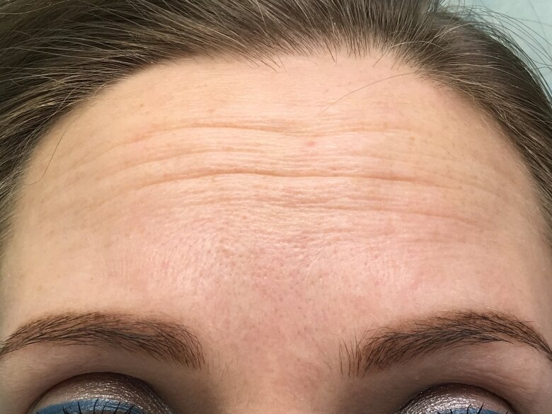 Морщины на лбу