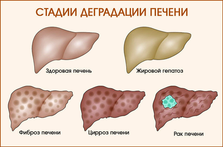 Как выглядит фиброз печени фото