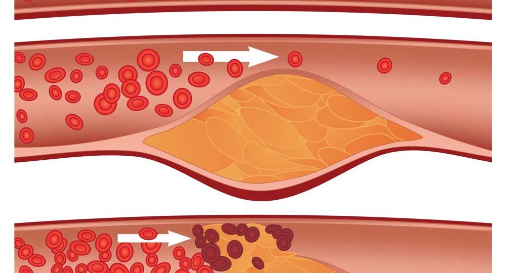 Когда появляются БЛЯШКИ в сосудах?