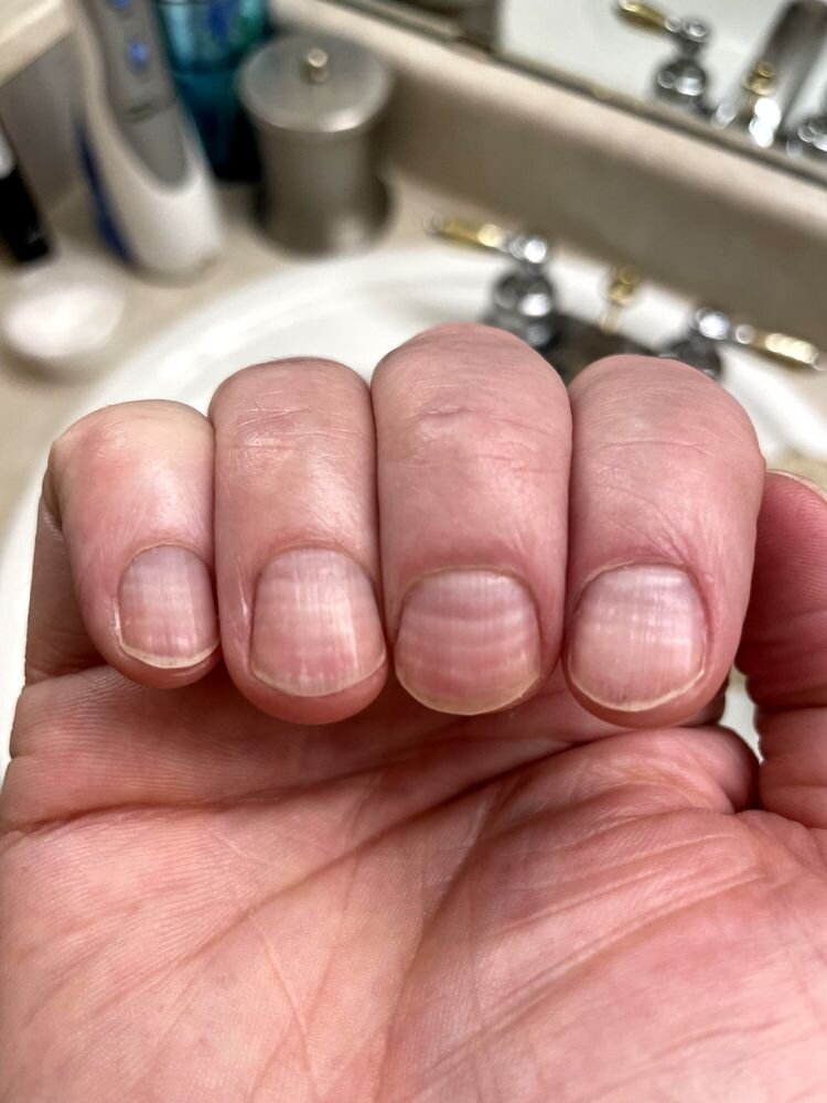 Источник: https://www.reddit.com/r/mildlyinteresting/comments/18ir8xi/6_lines_on_my_fingernails_one_for_each_chemo