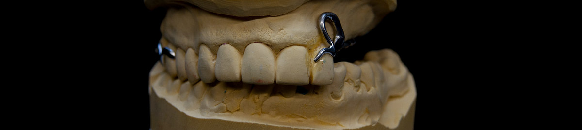 Каркас бюгельного протеза спереди.