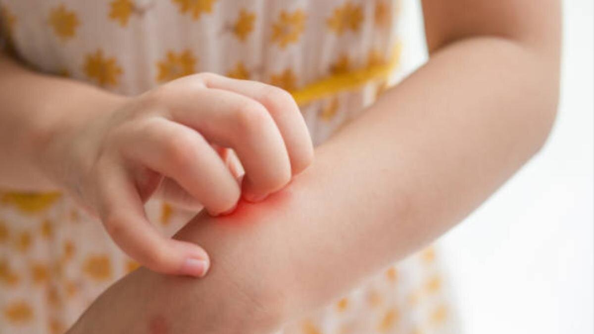    У ребенка чешется рука:iStockPhoto