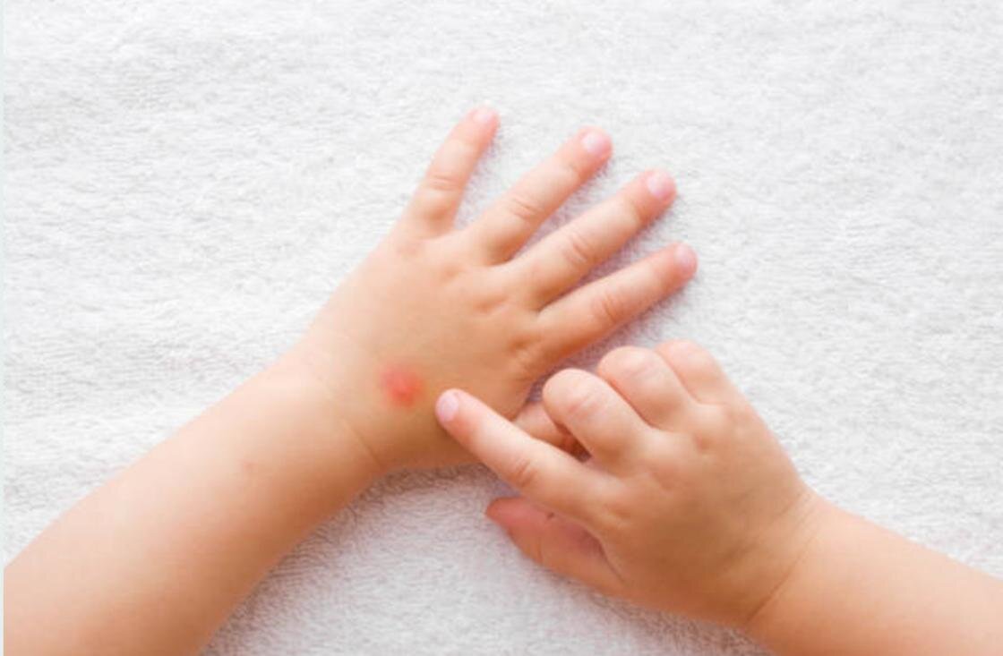    На ручке ребенка прыщик:iStockPhoto