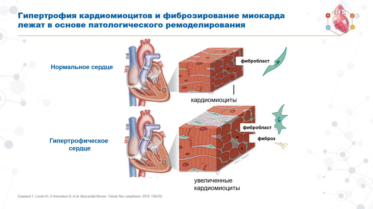 Лечение гипертрофии миокарда в Израиле