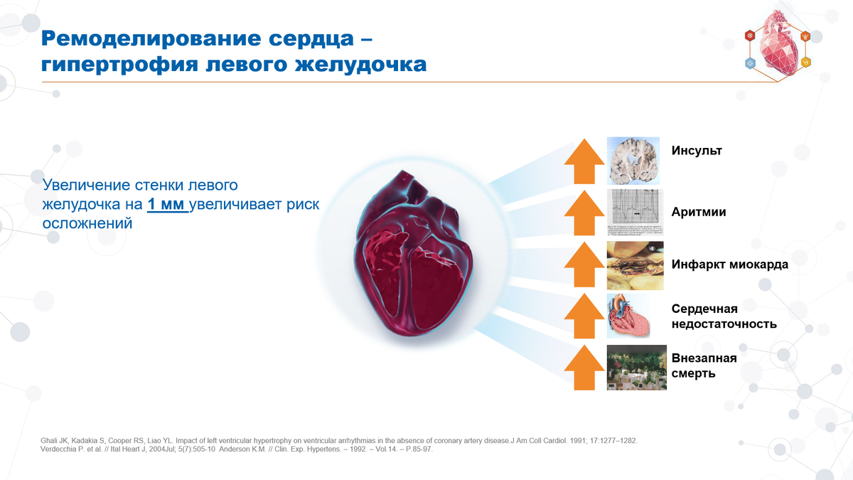 Аневризма левого желудочка сердца