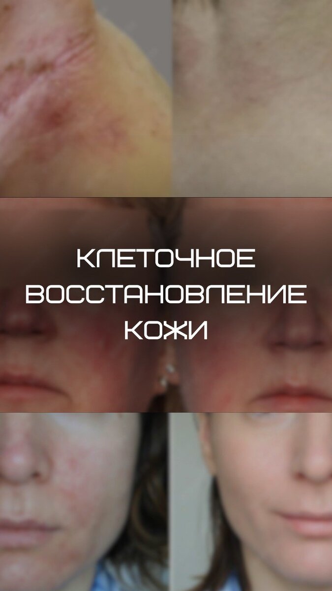 Регенерация кожи