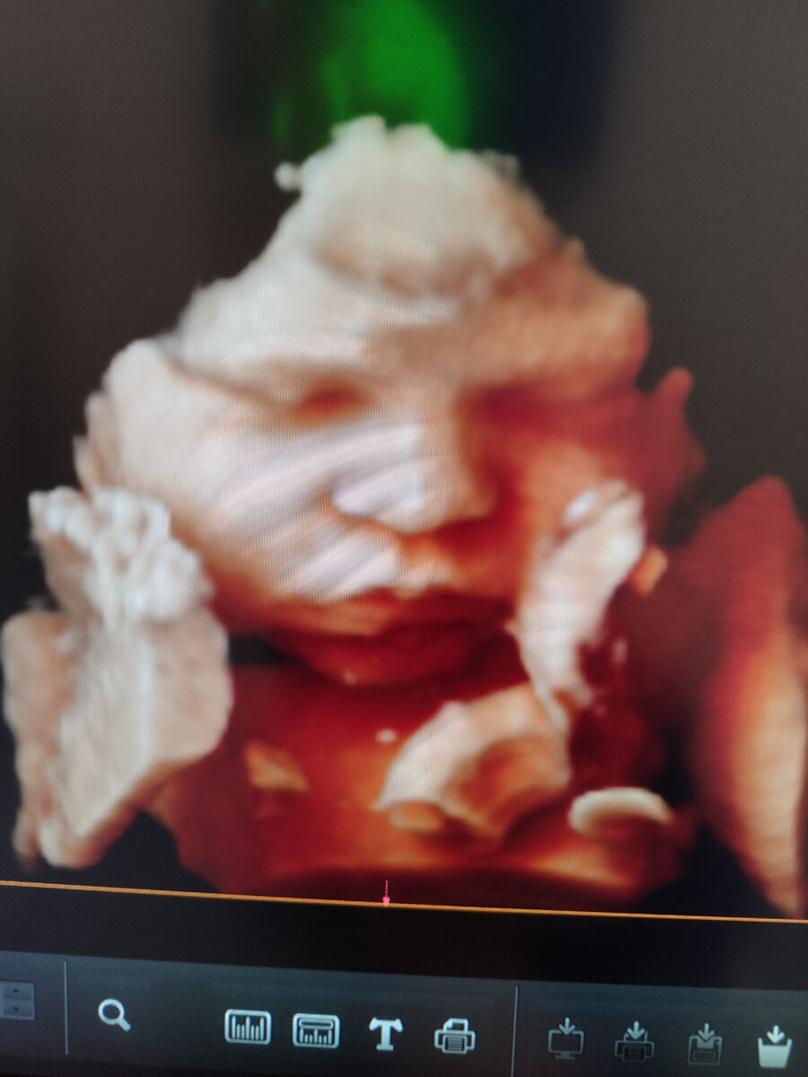 УЗИ 38 недель 