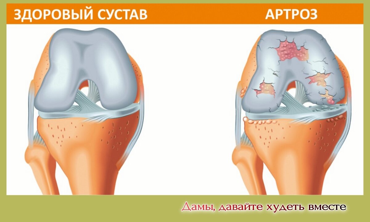 Здоровые суставы картинки