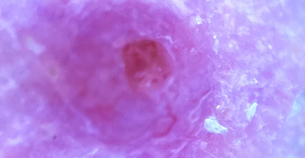 Базальноклеточная карцинома или ?