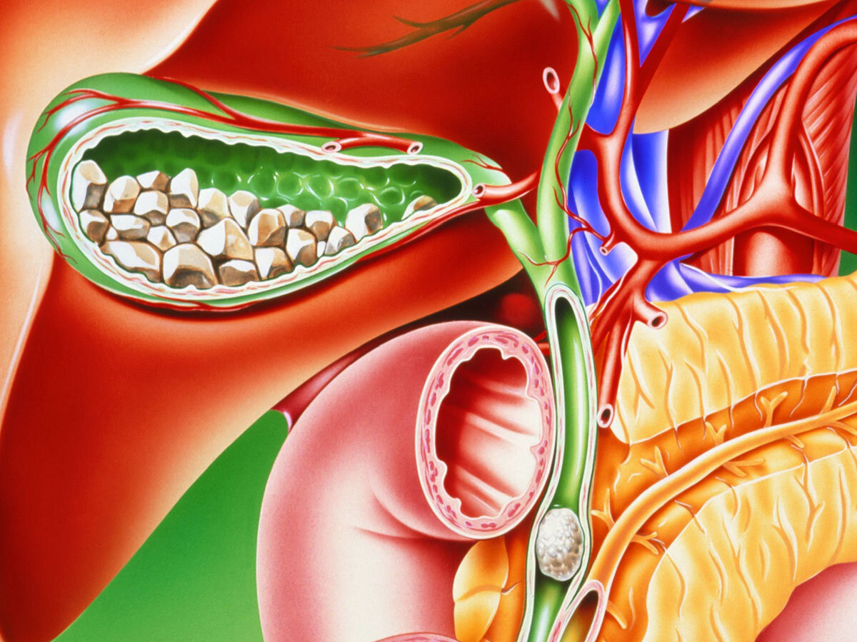 Что такое конкременты желчного пузыря