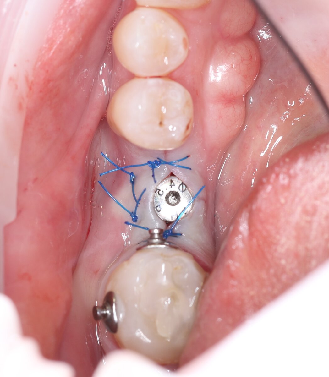 Пример. Финальное фото после немедленной имплантации. Формирователь десны виднеется из-под слизистой 