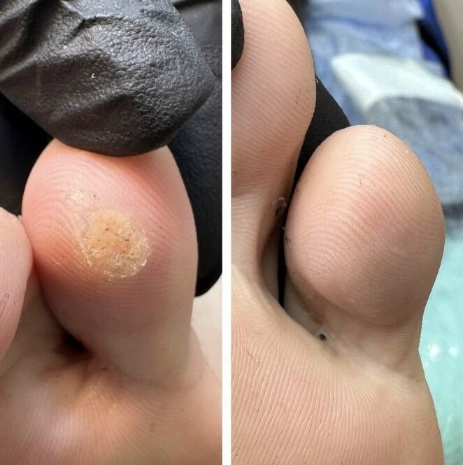 ВПЧ (вирус папилломы человека)