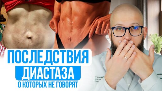 ПОСЛЕДСТВИЯ ДИАСТАЗА о которых молчат Фитнес тренера и доктора. Тест на Диастаз