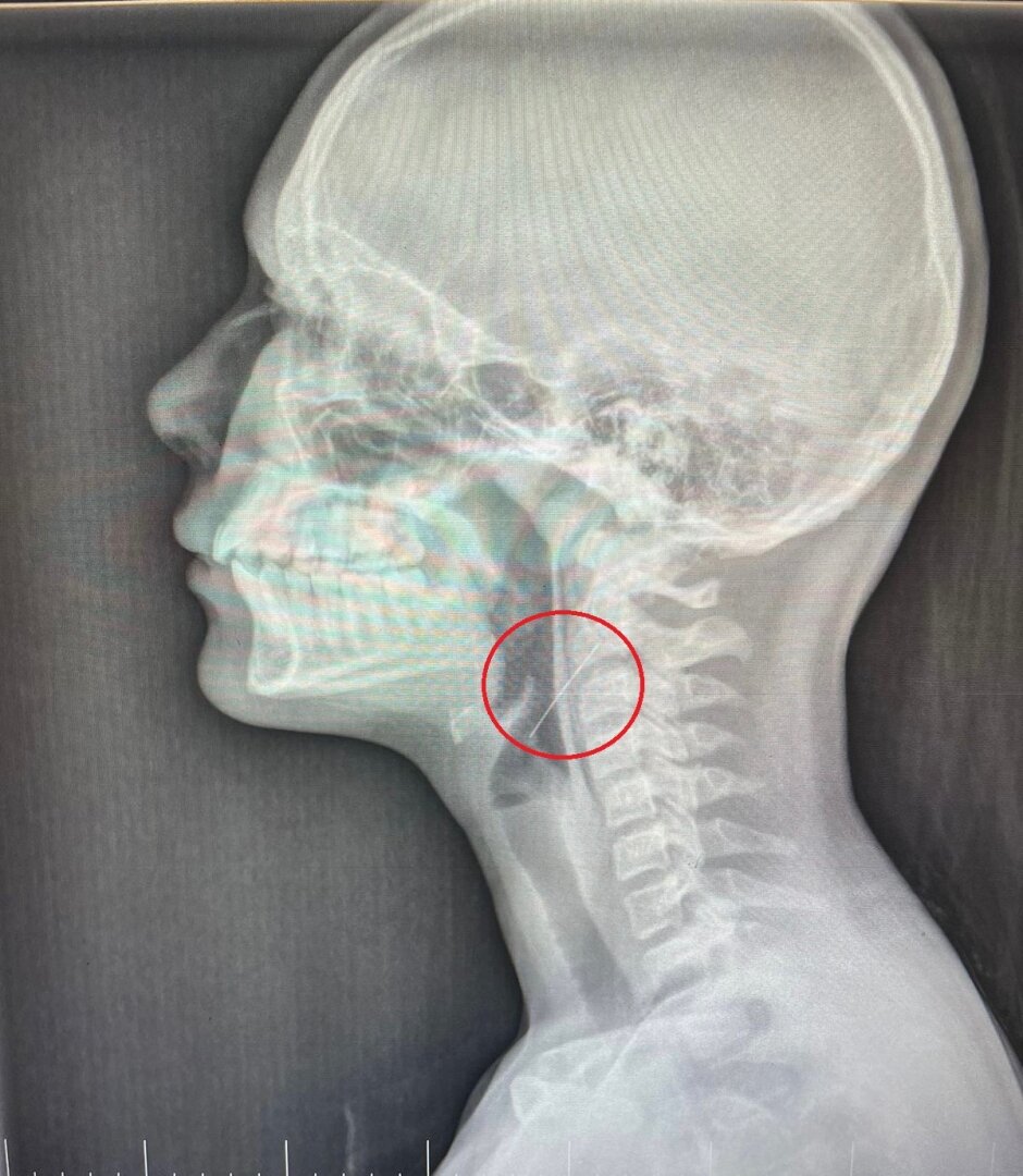 Иголка застряла.