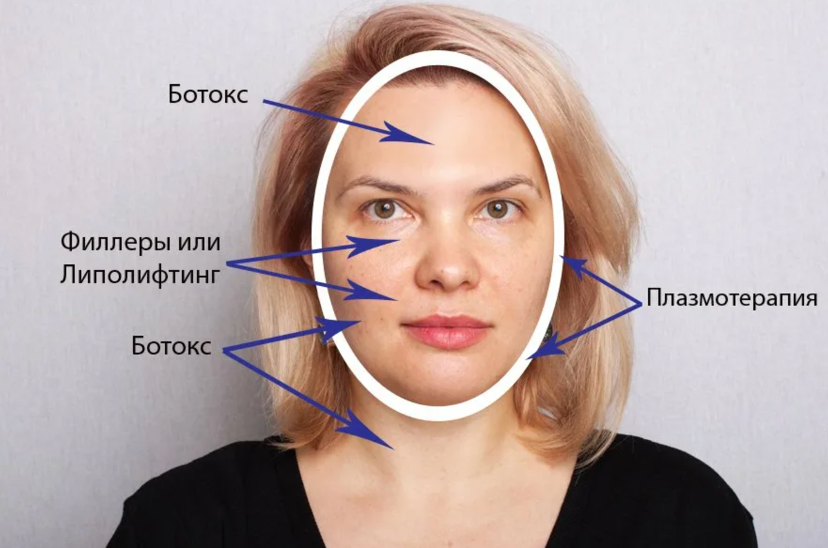 Ботокс лица зоны