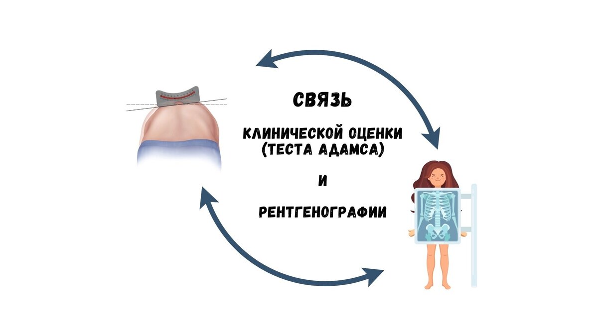 Связь клинической оценки (теста Адамса) и рентгенографии