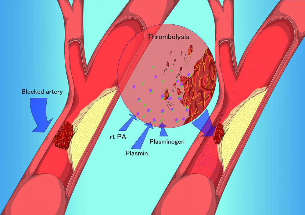 На левой картинке изображён тромб, полностью перекрывший артерию в том месте, где она изначально была узкой из-за бляшки. При растворении тромба проблема полностью не решена - бляшка осталась, и в любой момент может вновь проявить себя. Но тромболизис позволяет выиграть время до стентирования, которое устранит стеноз сосуда, что приведёт к улучшению самочувствия.