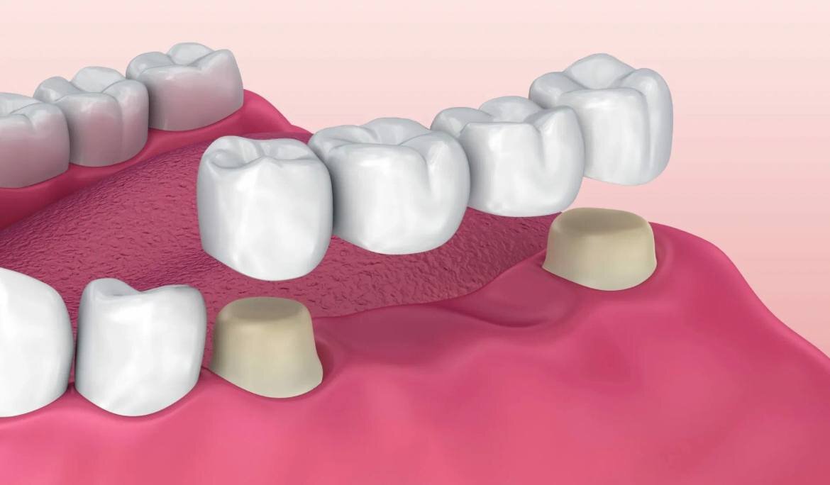 мостовидный протез