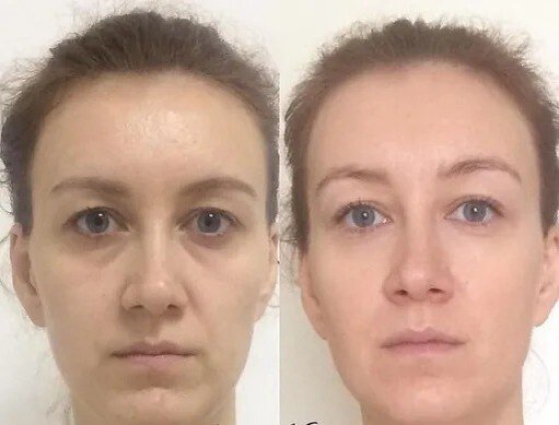 Миофасциальный массаж лица фото до и после