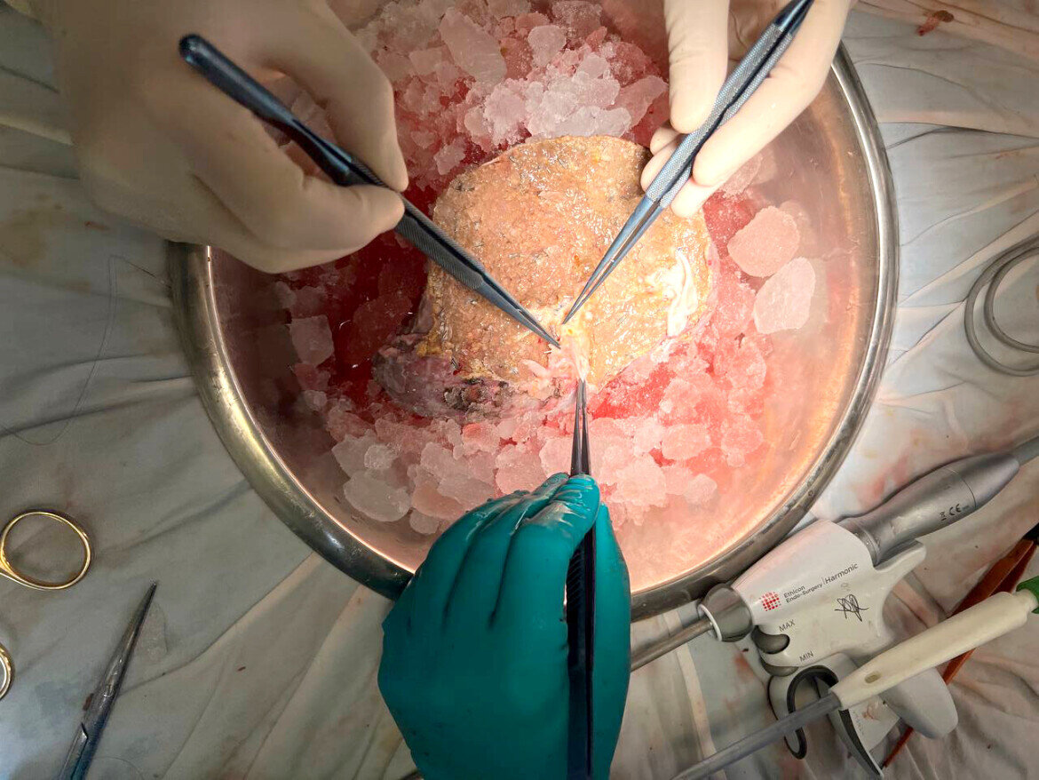 ​В печени пациента было множество паразитов – альвиококков. Они образовали огромную кисту. Фото: © предоставлено Александром Киршиным