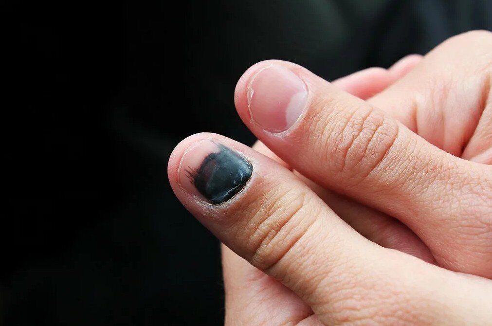 Повреждение ногтя