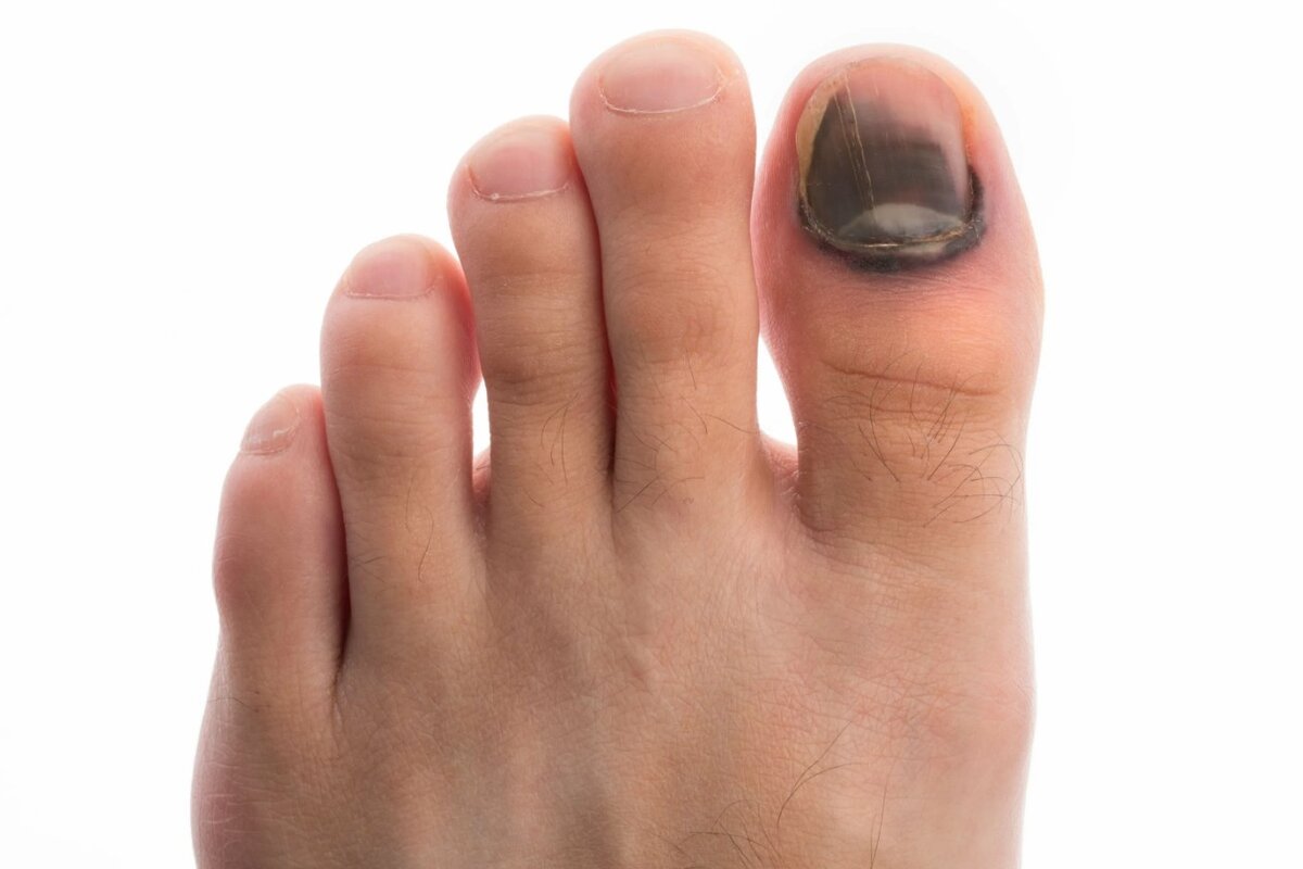 Лечение оторванного ногтя