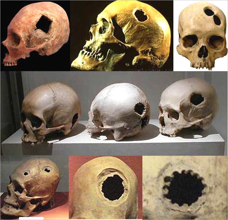 Вскрытие черепа человека. Трепанация черепа вскрытие. Череп с трепанацией черепа. Трепанация черепа в древности. Инки трепанация черепа.