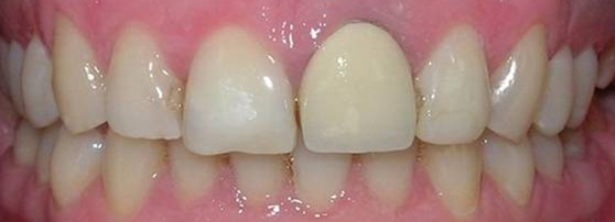 При очень тонких зубах, недостаточном объеме сошлифовывания, свет, отражаясь от поверхности коронки, не дает возможности добиться хорошей эстетики при изготовлении металлокерамической коронки.