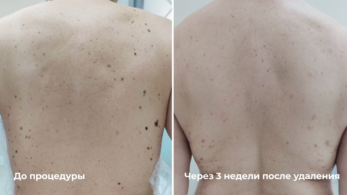 Лазерное удаление множественных кератом на спине