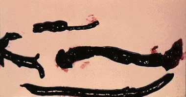 Так выглядят тромбы - сгустки крови