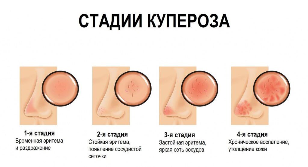 Развитие купероза. Фото взято из открытых источников.