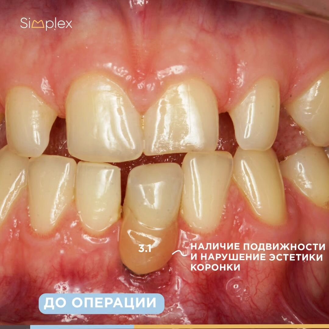 Состояние до операции - коронка с искусственной розовой десной