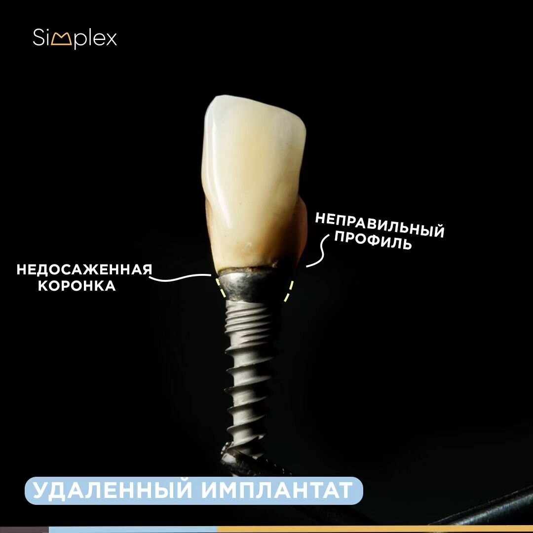 Удаленный имплантат и коронка