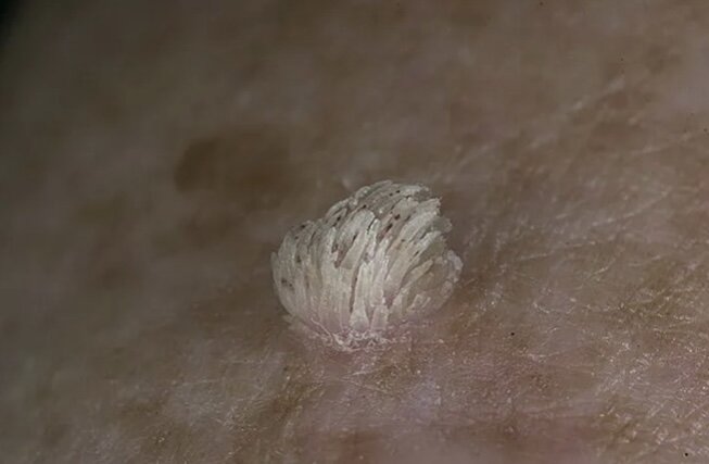 Роговая (кожный рог)
 