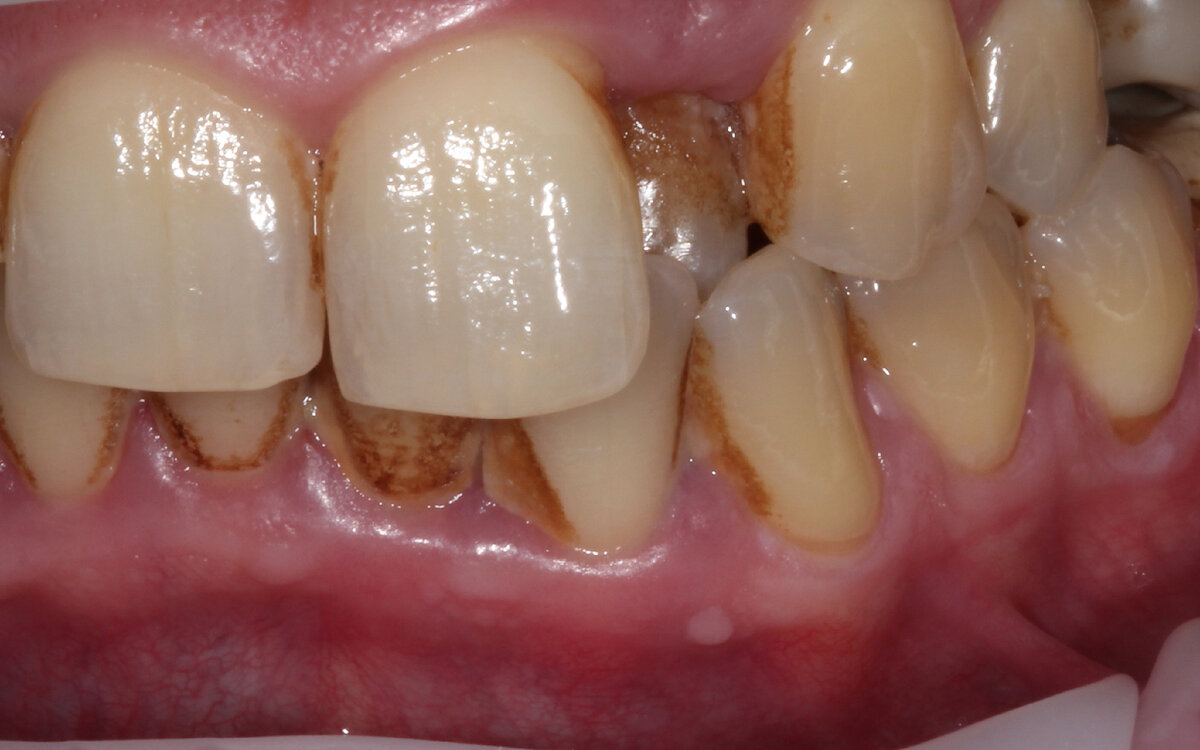 При такой скученности зубов обычная зубная щетка и зубная нить будут недостаточно эффективны, и нужно дополнительно чистить зубы монопучковой зубной щеткой 
