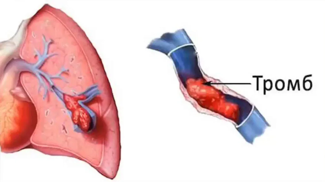 Артерия тромб удаление. Тромб в легочной артерии. Тромбэктомия легочной артерии. Эмболия тромбом легочной артерии.