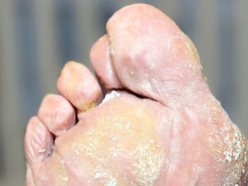 Грибок на пальцах ног