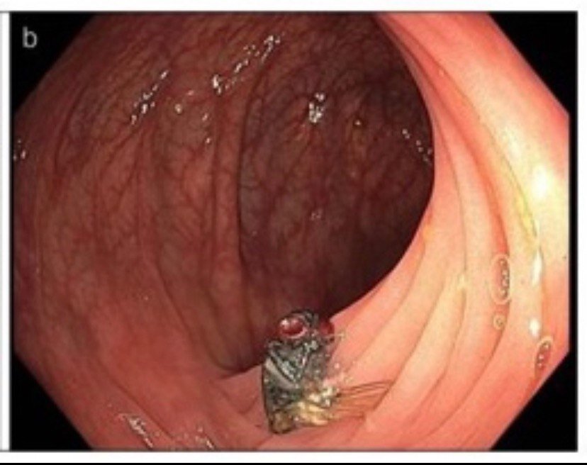 Фото 1. Муха в толстой кишке.