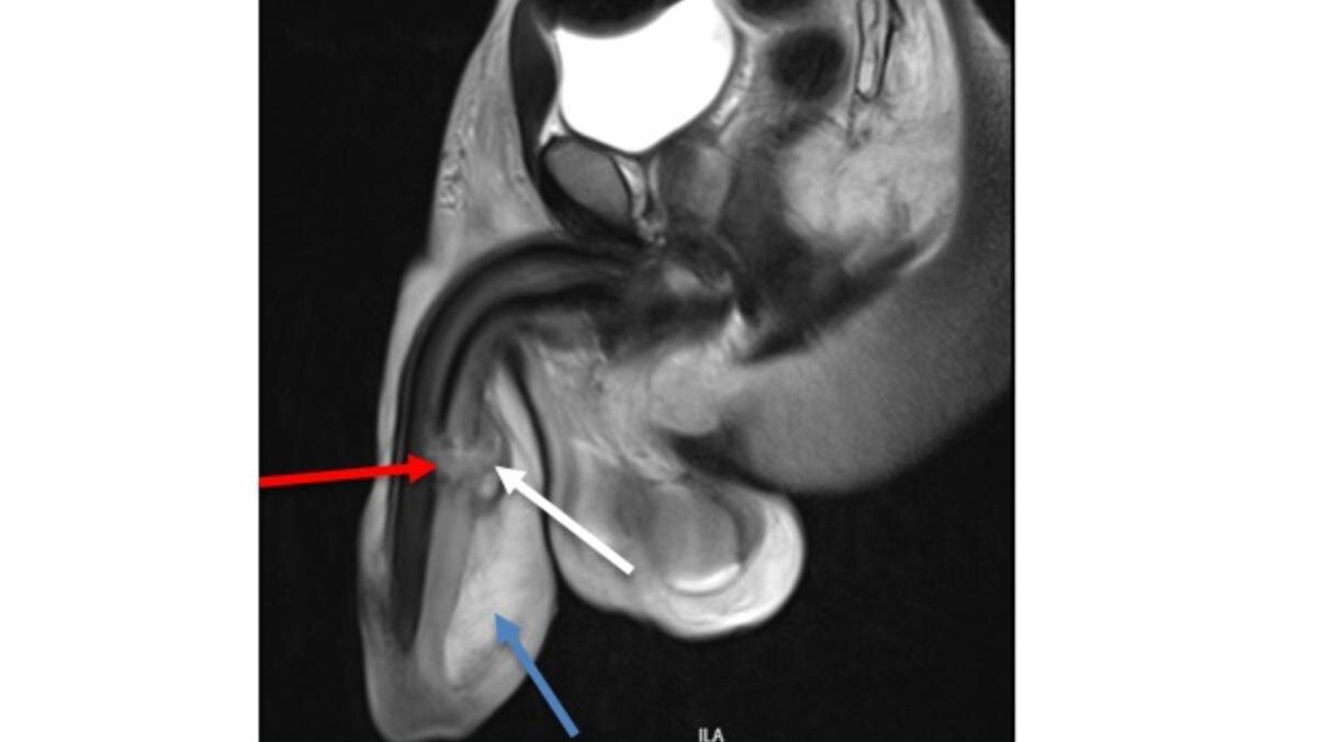 Фото 1. Перелом пещеристых тел.