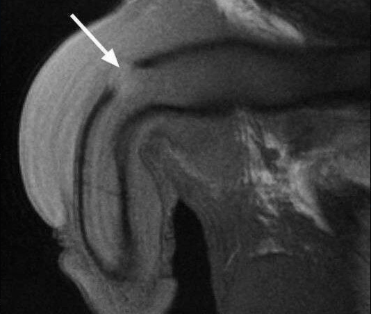 Фото 2. Разрыв футляра. 