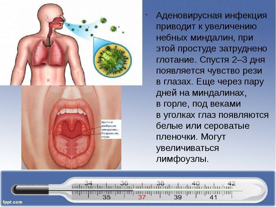 Аденовирусная инфекция у детей